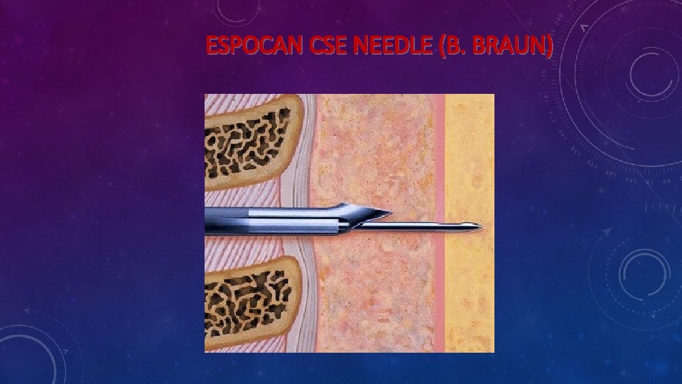ESPOCAN CSE NEEDLE (B. BRAUN) ESPOCAN CSE NEEDLE (B. BRAUN)