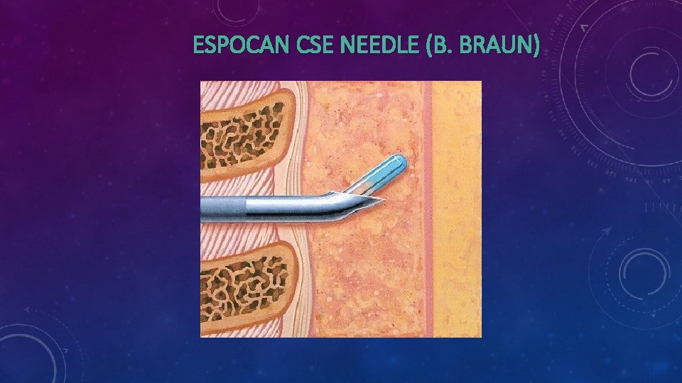 ESPOCAN CSE NEEDLE (B. BRAUN) ESPOCAN CSE NEEDLE (B. BRAUN)