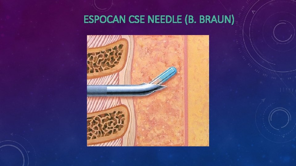 ESPOCAN CSE NEEDLE (B. BRAUN) 