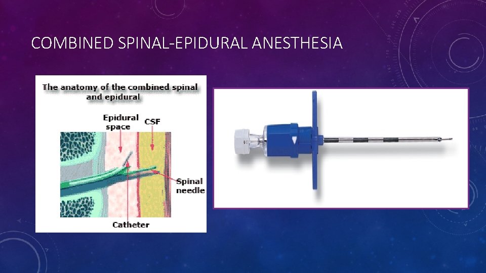 COMBINED SPINAL-EPIDURAL ANESTHESIA COMBINED SPINAL-EPIDURAL ANESTHESIA