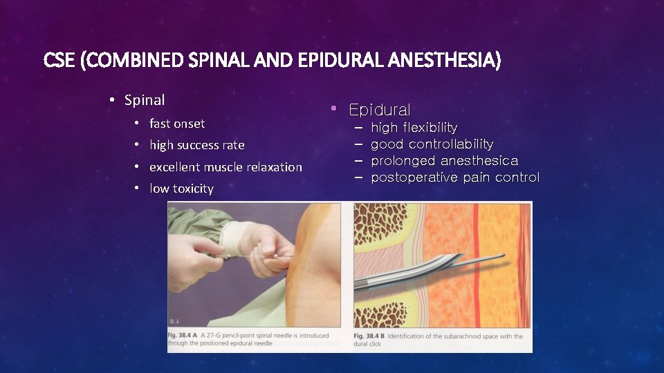 CSE (COMBINED SPINAL AND EPIDURAL ANESTHESIA) • Spinal • fast onset • high success