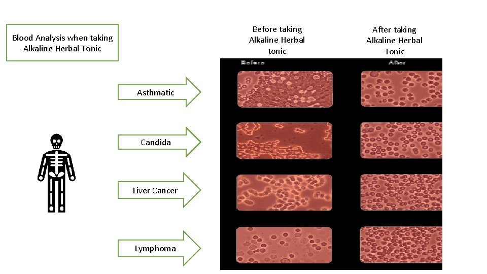Before taking Alkaline Herbal tonic Blood Analysis when taking Alkaline Herbal Tonic Asthmatic Candida