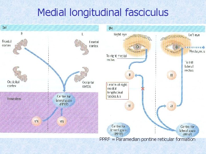 Medial longitudinal fasciculus PPRF = Paramedian pontine reticular formation 