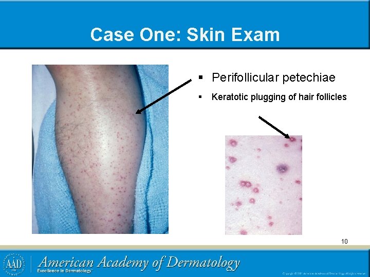 Case One: Skin Exam § Perifollicular petechiae § Keratotic plugging of hair follicles 10