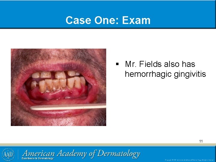 Case One: Exam § Mr. Fields also has hemorrhagic gingivitis 11 
