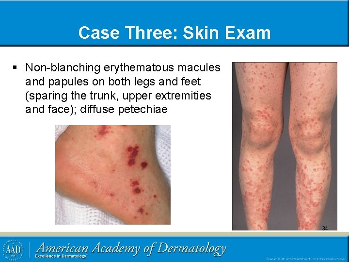 Case Three: Skin Exam § Non-blanching erythematous macules and papules on both legs and