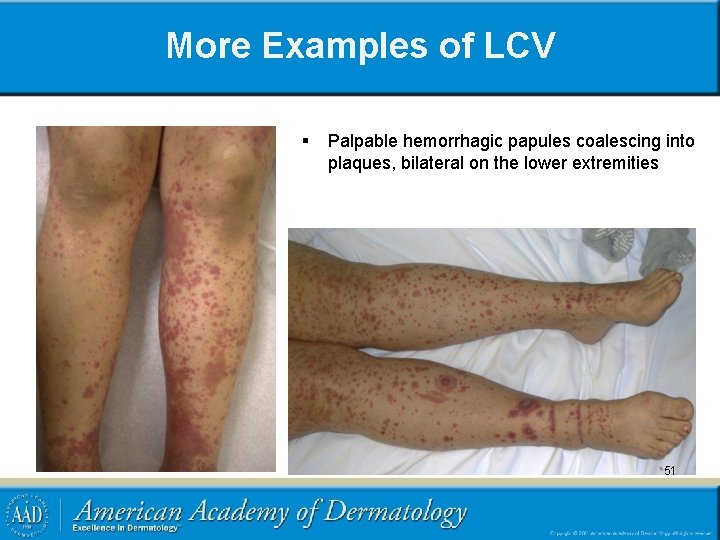 More Examples of LCV § Palpable hemorrhagic papules coalescing into plaques, bilateral on the