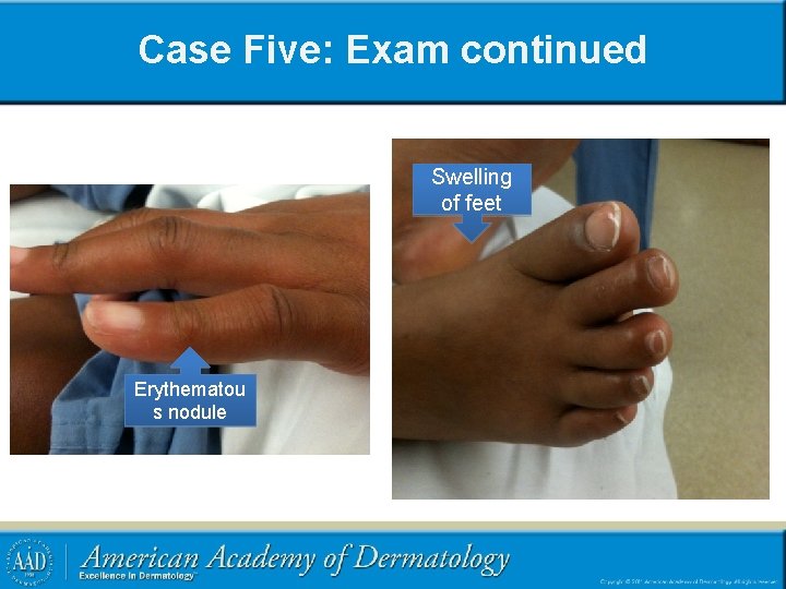 Case Five: Exam continued Swelling of feet Erythematou s nodule 