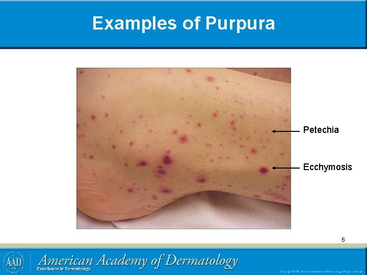 Examples of Purpura Petechia Ecchymosis 6 