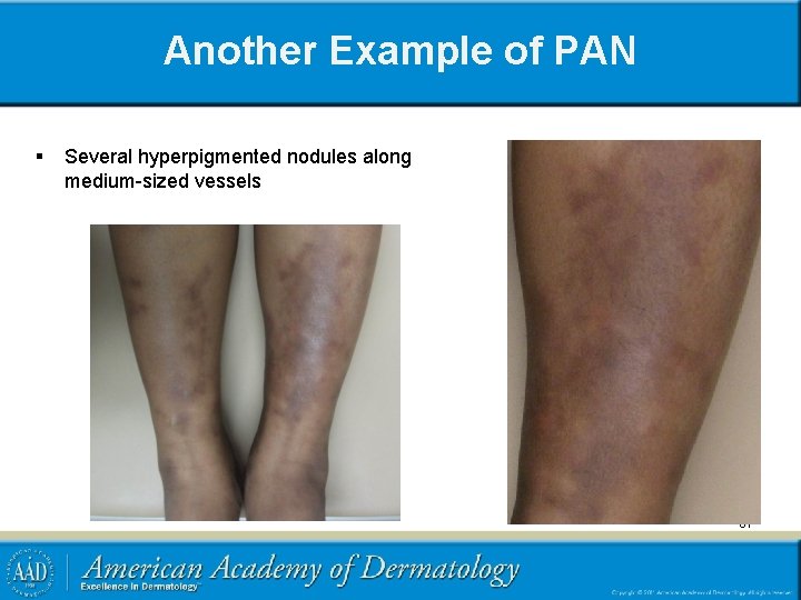 Another Example of PAN § Several hyperpigmented nodules along medium-sized vessels 61 