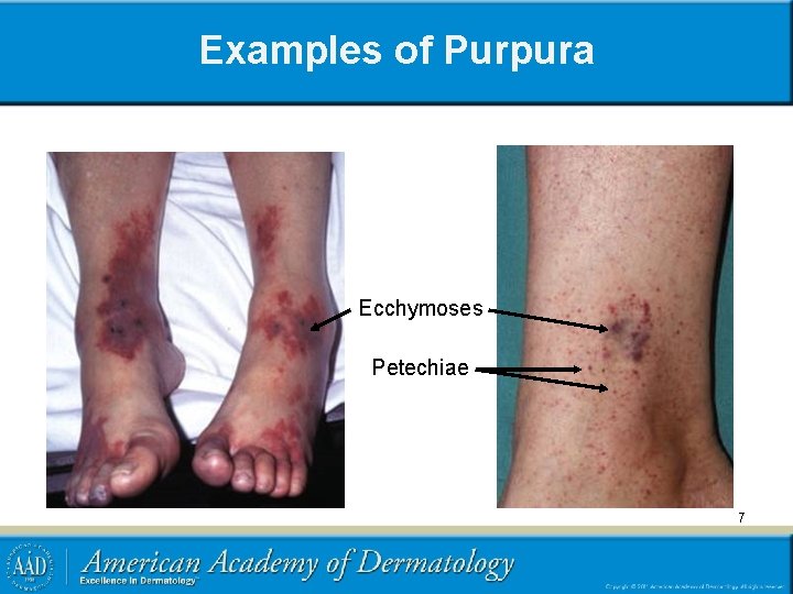 Examples of Purpura Ecchymoses Petechiae 7 