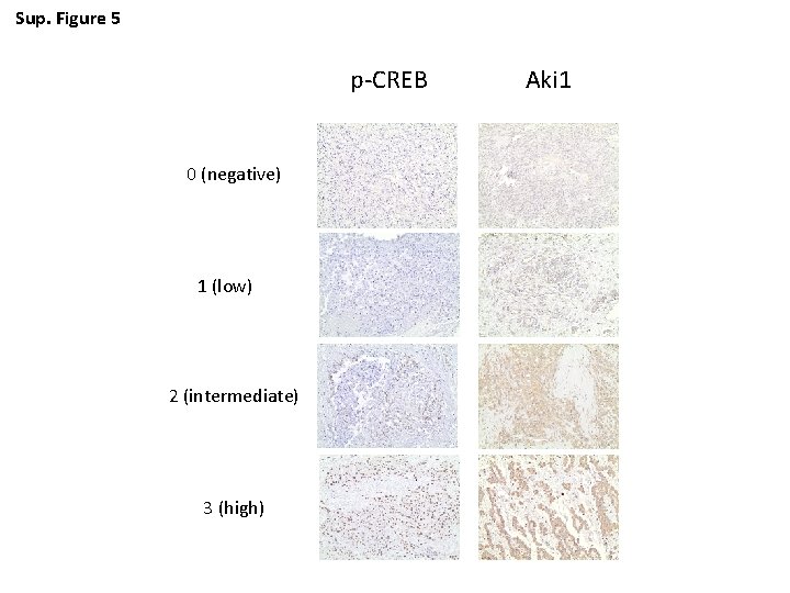 Sup. Figure 5 p-CREB 0 (negative) 1 (low) 2 (intermediate) 3 (high) Aki 1