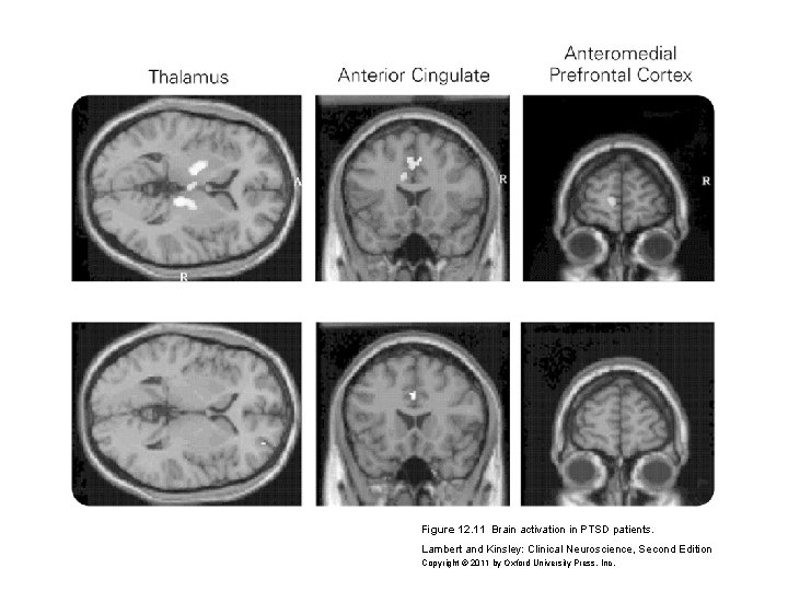 Figure 12. 11 Brain activation in PTSD patients. Lambert and Kinsley: Clinical Neuroscience, Second