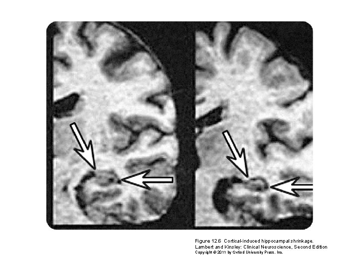 Figure 12. 6 Cortical-induced hippocampal shrinkage. Lambert and Kinsley: Clinical Neuroscience, Second Edition Copyright