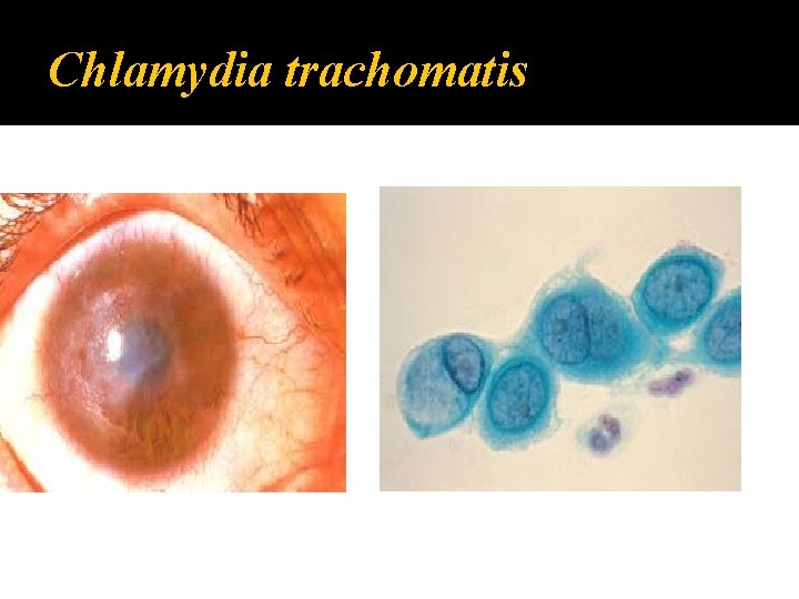 Chlamydia trachomatis 