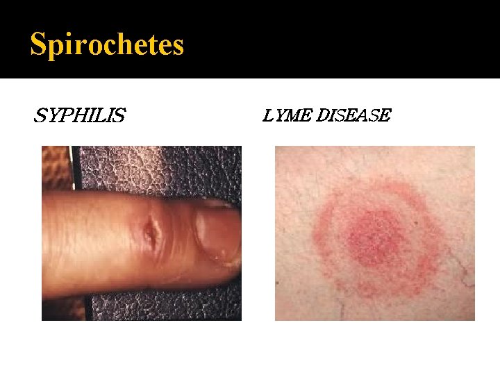 Spirochetes SYPHILIS LYME DISEASE 