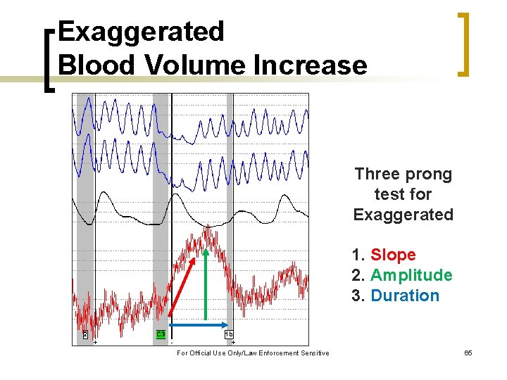 Exaggerated Blood Volume Increase Three prong test for Exaggerated 1. Slope 2. Amplitude 3.