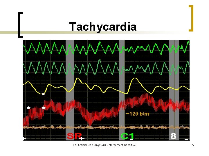 Tachycardia ~120 b/m For Official Use Only/Law Enforcement Sensitive 77 