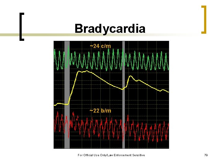 Bradycardia ~24 c/m ~22 b/m For Official Use Only/Law Enforcement Sensitive 79 