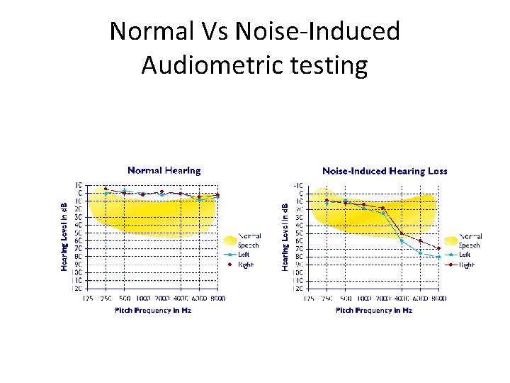Normal Vs Noise-Induced Audiometric testing 