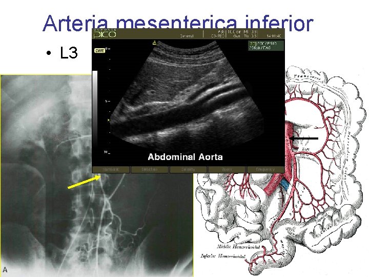 Arteria mesenterica inferior • L 3 