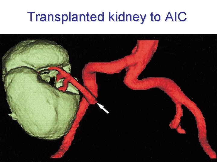 Transplanted kidney to AIC 