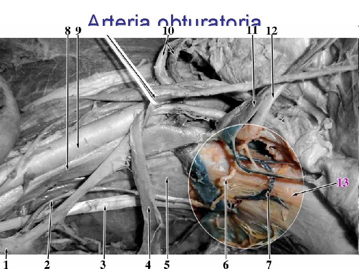 Arteria obturatoria • 2 nd ventral branch • from anterior division of AII •