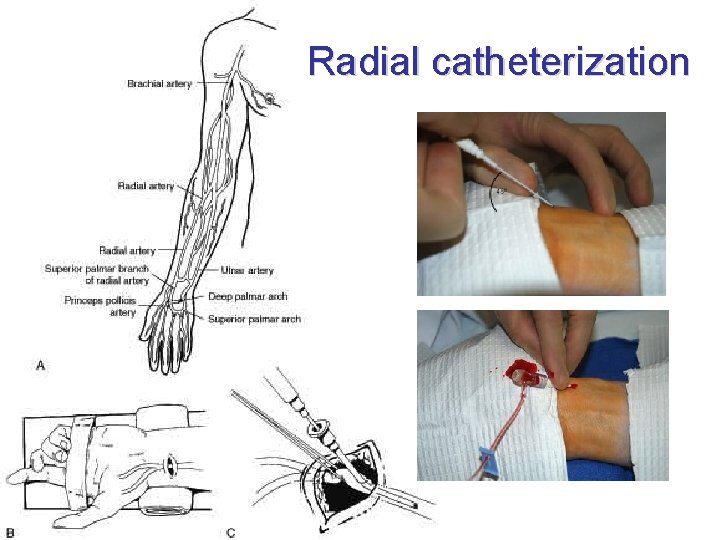 Radial catheterization 