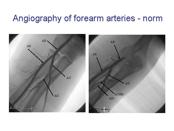 Angiography of forearm arteries - norm AB AB AR AR AU AU AIC ACNM