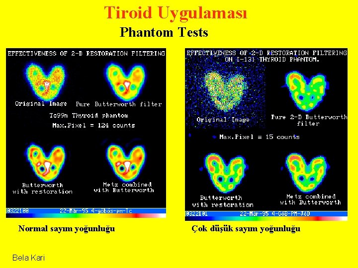 Tiroid Uygulaması Phantom Tests Normal sayım yoğunluğu Bela Kari Çok düşük sayım yoğunluğu 