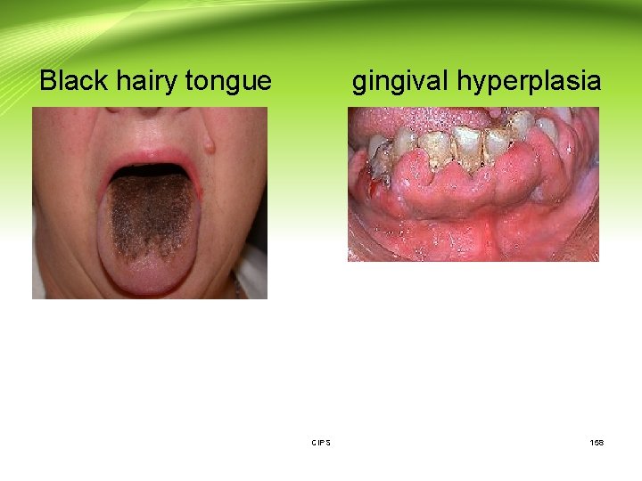 Black hairy tongue gingival hyperplasia CIPS 158 