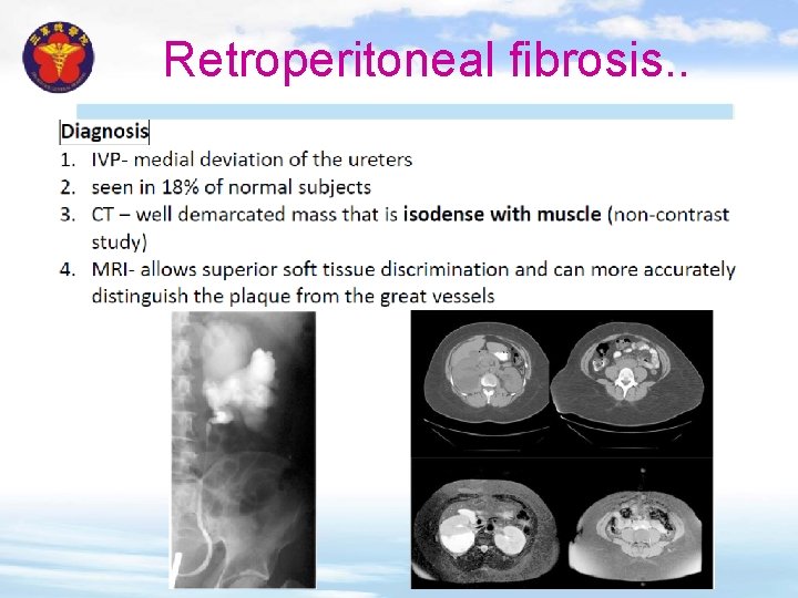 Retroperitoneal fibrosis. . 