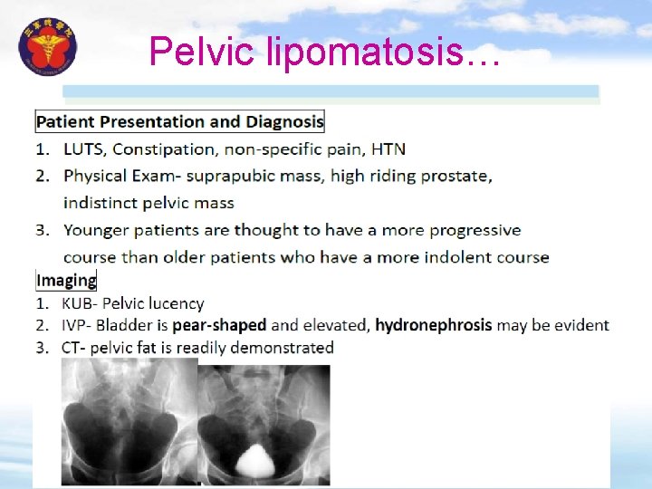 Pelvic lipomatosis… 