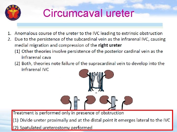 Circumcaval ureter 