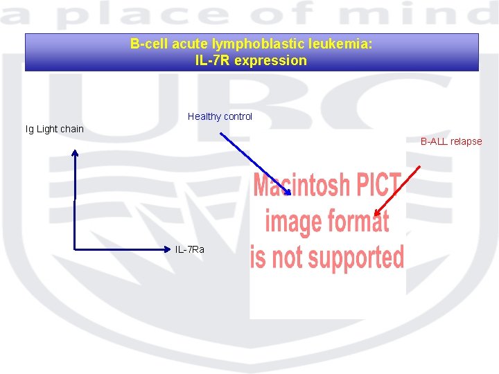 B-cell acute lymphoblastic leukemia: IL-7 R expression Healthy control Ig Light chain B-ALL relapse