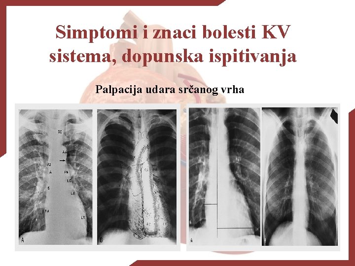 Simptomi i znaci bolesti KV sistema, dopunska ispitivanja Palpacija udara srčanog vrha 
