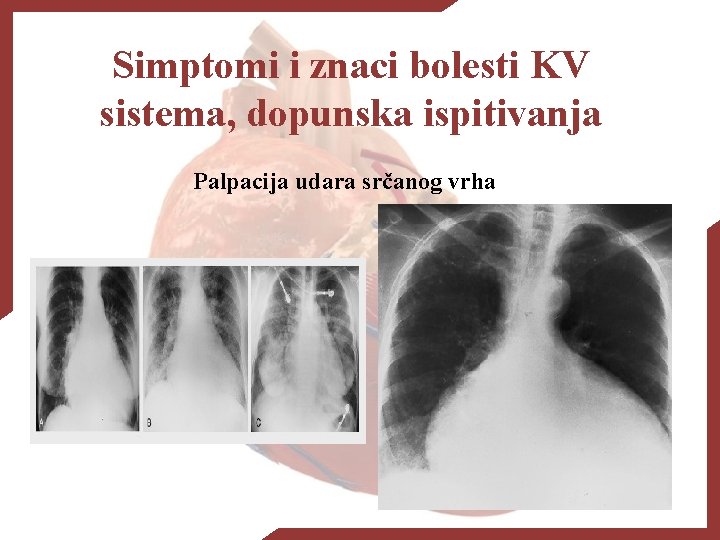 Simptomi i znaci bolesti KV sistema, dopunska ispitivanja Palpacija udara srčanog vrha 