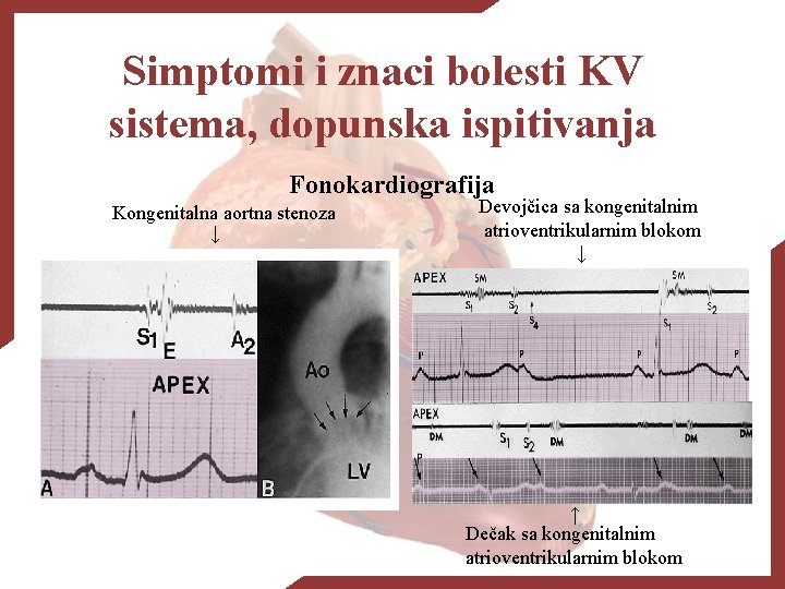 Simptomi i znaci bolesti KV sistema, dopunska ispitivanja Fonokardiografija Kongenitalna aortna stenoza ↓ Devojčica