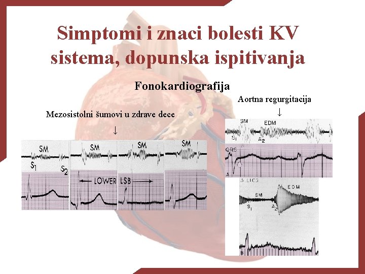 Simptomi i znaci bolesti KV sistema, dopunska ispitivanja Fonokardiografija Mezosistolni šumovi u zdrave dece