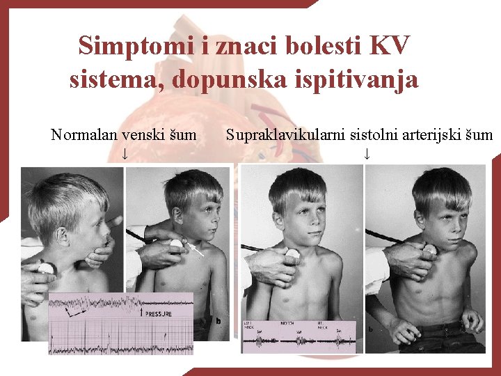 Simptomi i znaci bolesti KV sistema, dopunska ispitivanja Normalan venski šum ↓ Supraklavikularni sistolni