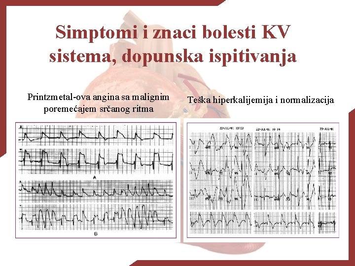 Simptomi i znaci bolesti KV sistema, dopunska ispitivanja Printzmetal-ova angina sa malignim poremećajem srčanog