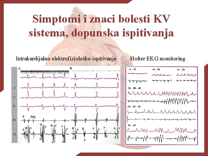 Simptomi i znaci bolesti KV sistema, dopunska ispitivanja Intrakardijalno elektrofiziološko ispitivanje Holter EKG monitoring