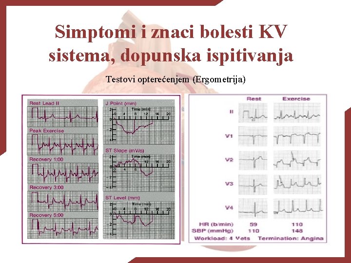 Simptomi i znaci bolesti KV sistema, dopunska ispitivanja Testovi opterećenjem (Ergometrija) 