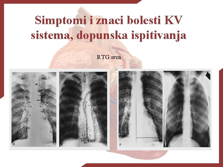 Simptomi i znaci bolesti KV sistema, dopunska ispitivanja RTG srca 