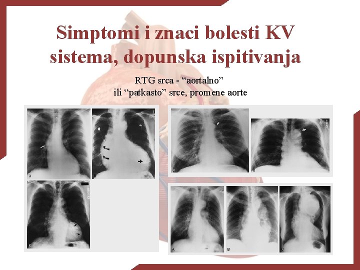 Simptomi i znaci bolesti KV sistema, dopunska ispitivanja RTG srca - “aortalno” ili “patkasto”