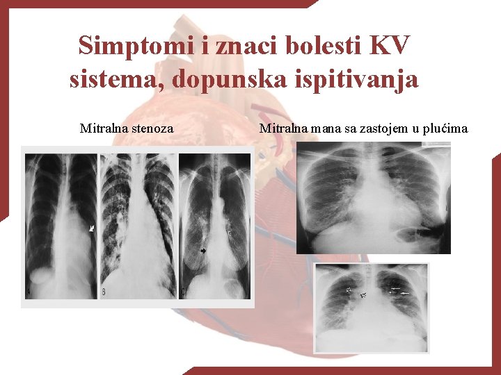 Simptomi i znaci bolesti KV sistema, dopunska ispitivanja Mitralna stenoza Mitralna mana sa zastojem