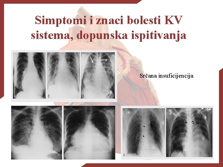 Simptomi i znaci bolesti KV sistema, dopunska ispitivanja Srčana insuficijencija 