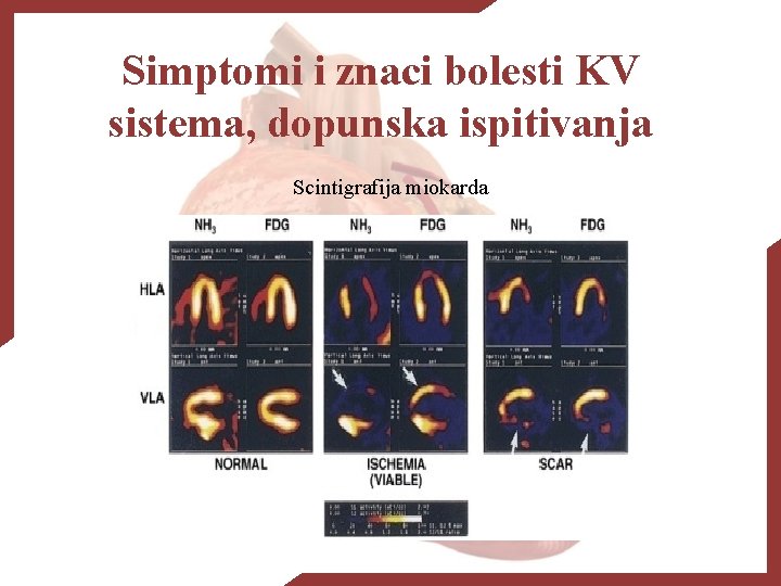 Simptomi i znaci bolesti KV sistema, dopunska ispitivanja Scintigrafija miokarda 