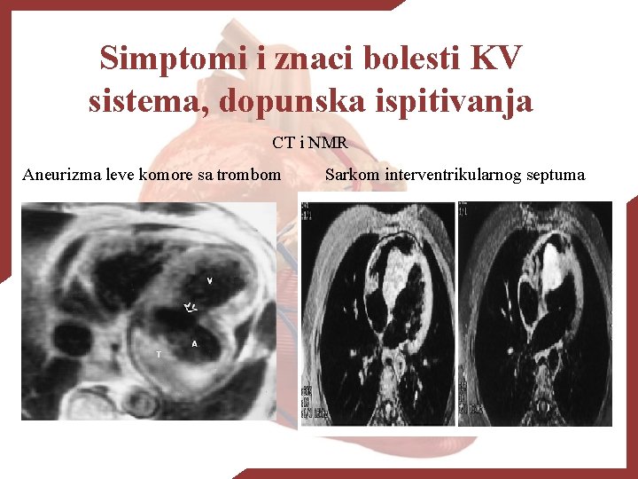 Simptomi i znaci bolesti KV sistema, dopunska ispitivanja CT i NMR Aneurizma leve komore