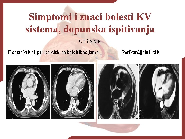 Simptomi i znaci bolesti KV sistema, dopunska ispitivanja CT i NMR Konstriktivni perikarditis sa